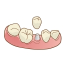 歯を失った場合の治療法　インプラント